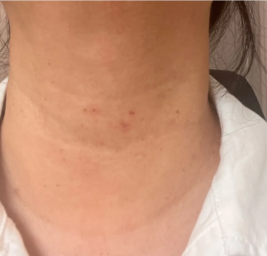 Smooth, clear neck after skin tag removal treatment at Dr. Carol Ng's clinic in Victoria, BC