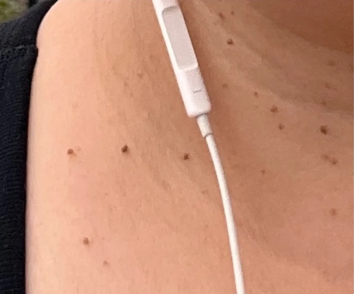 Multiple benign skin tags on the neck and collarbone before removal at Dr. Carol Ng's clinic in Victoria, BC